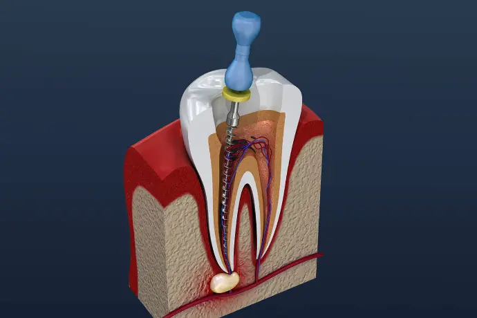 Trattamenti di endodonzia